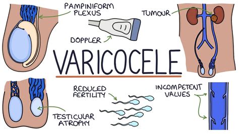 operații microchirurgicale pentru varicele testiculare